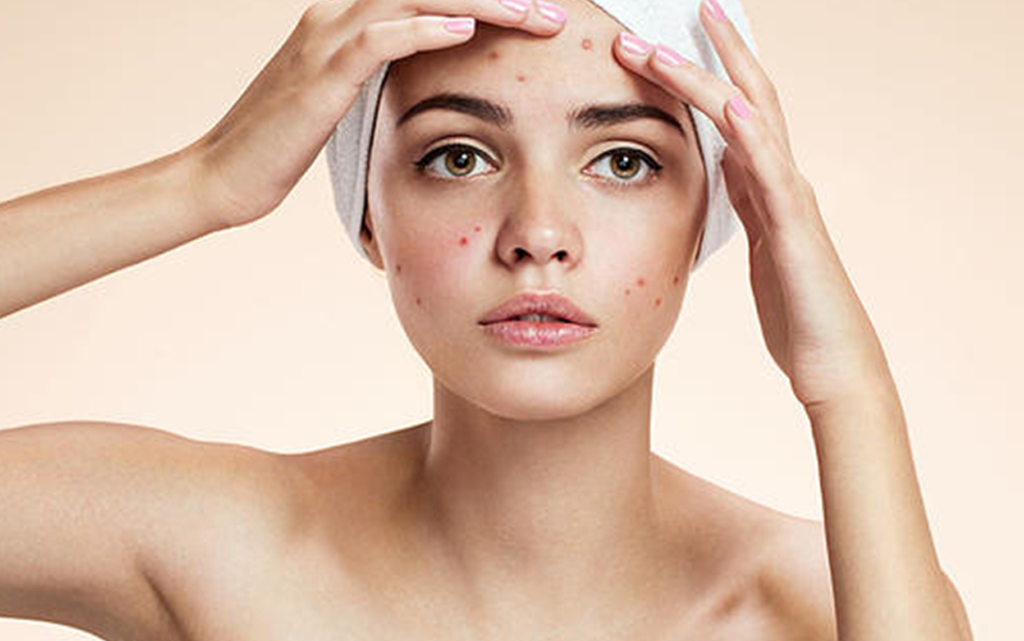 Nên và không nên làm gì để chăm sóc da nhờn mụn hiệu quả?
